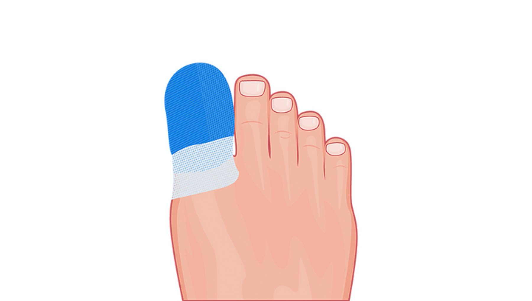 Ingrown toenails and nail surgery- The PNA.