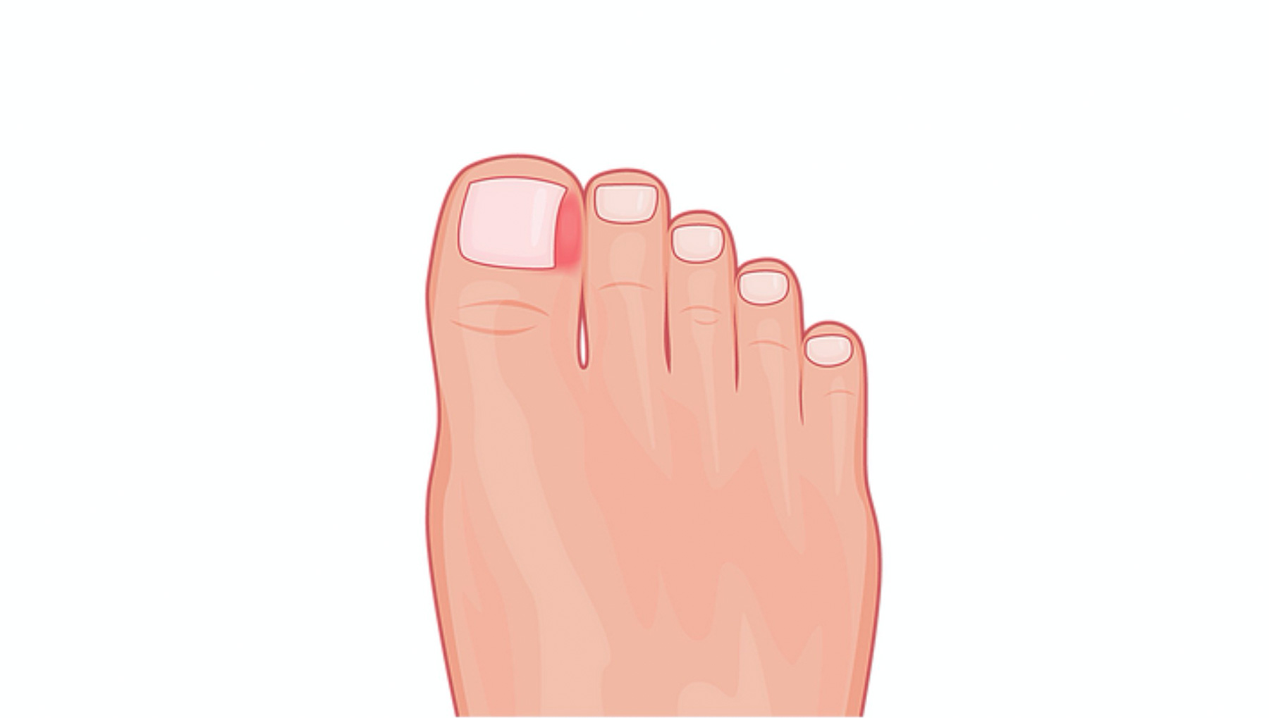 What is an ingrown toenail? - Ingrown Toenail Clinics